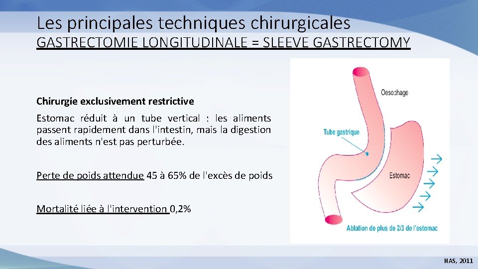 Les principales techniques chirurgicales GASTRECTOMIE LONGITUDINALE = SLEEVE GASTRECTOMY Chirurgie exclusivement restrictive Estomac réduit