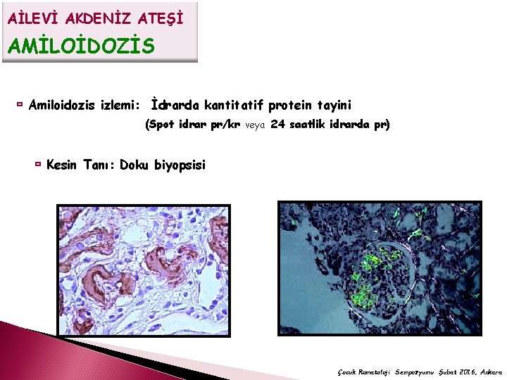 AİLEVİ AKDENİZ ATEŞİ AMİLOİDOZİS Amiloidozis izlemi: İdrarda kantitatif protein tayini (Spot idrar pr/kr veya