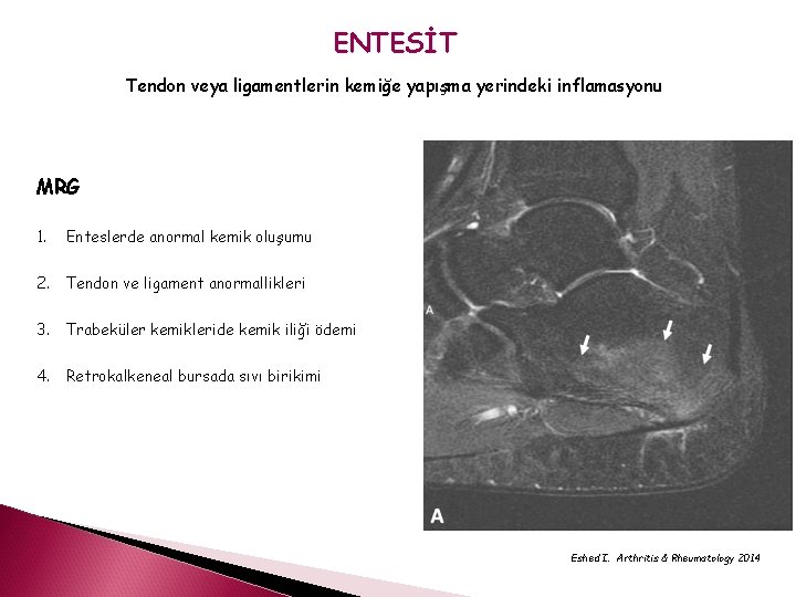 ENTESİT Tendon veya ligamentlerin kemiğe yapışma yerindeki inflamasyonu MRG 1. Enteslerde anormal kemik oluşumu
