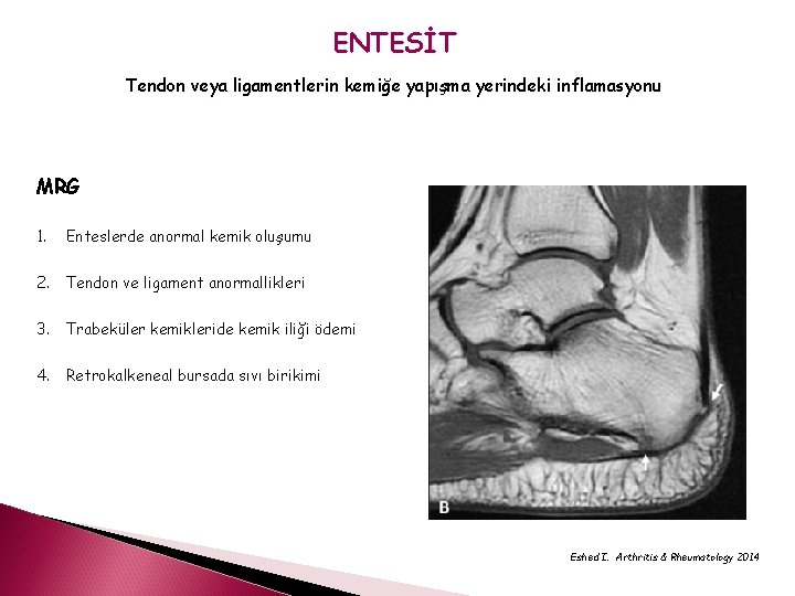 ENTESİT Tendon veya ligamentlerin kemiğe yapışma yerindeki inflamasyonu MRG 1. Enteslerde anormal kemik oluşumu