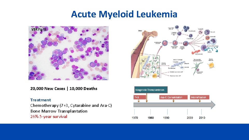 Acute Myeloid Leukemia 20, 000 New Cases | 10, 000 Deaths Treatment Chemotherapy (7+3,