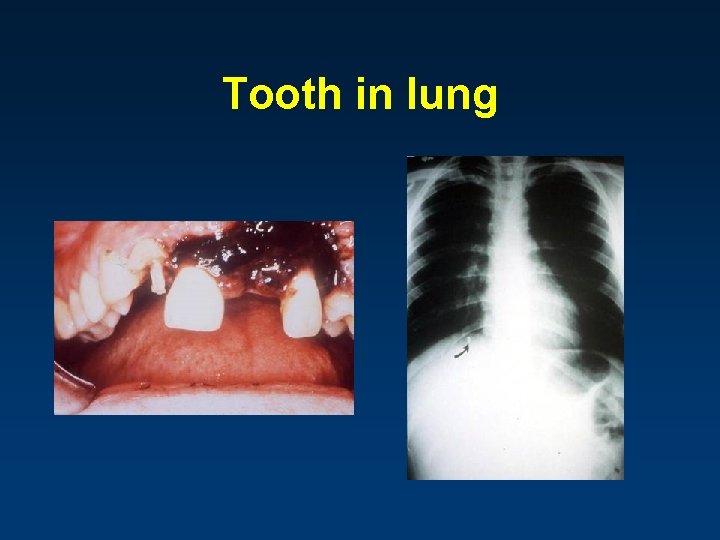 Tooth in lung 