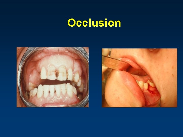 Occlusion 