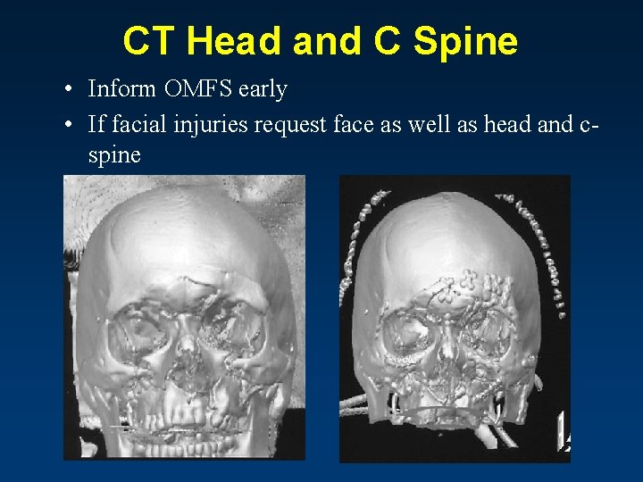 CT Head and C Spine • Inform OMFS early • If facial injuries request