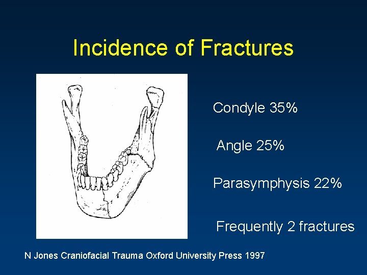 Incidence of Fractures Condyle 35% Angle 25% Parasymphysis 22% Frequently 2 fractures N Jones