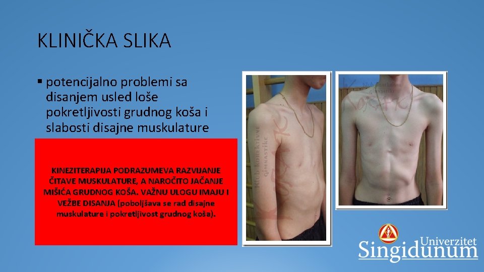 KLINIČKA SLIKA § potencijalno problemi sa disanjem usled loše pokretljivosti grudnog koša i slabosti