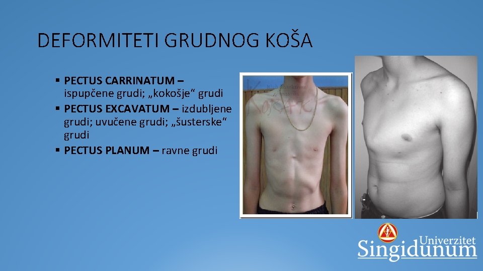 DEFORMITETI GRUDNOG KOŠA § PECTUS CARRINATUM – ispupčene grudi; „kokošje“ grudi § PECTUS EXCAVATUM