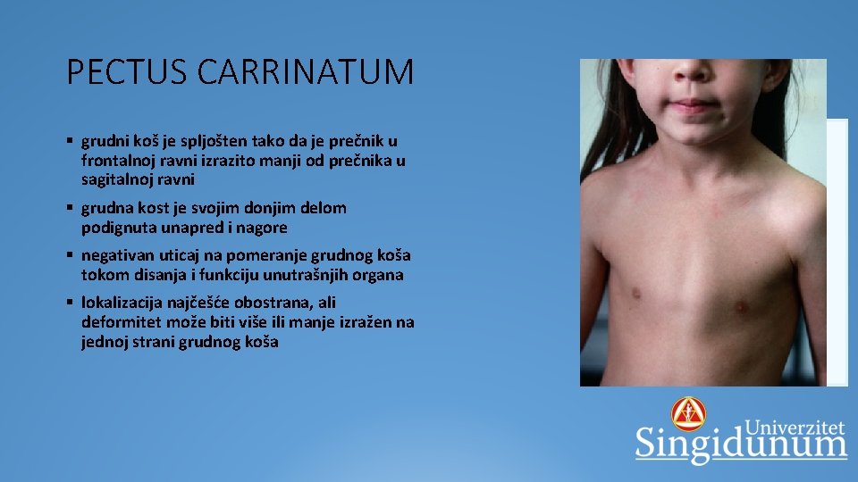PECTUS CARRINATUM § grudni koš je spljošten tako da je prečnik u frontalnoj ravni