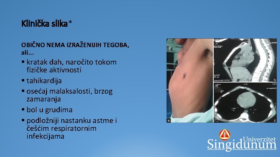 Klinička slika* OBIČNO NEMA IZRAŽENIJIH TEGOBA, ali. . . § kratak dah, naročito tokom