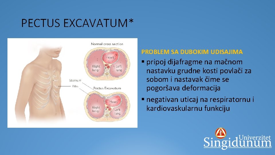 PECTUS EXCAVATUM* GRUDNI KOŠ SPLJOŠTEN U SUPROTNOM SMISLU NEGO KOG PECTUS CARINATUMA § izrazito