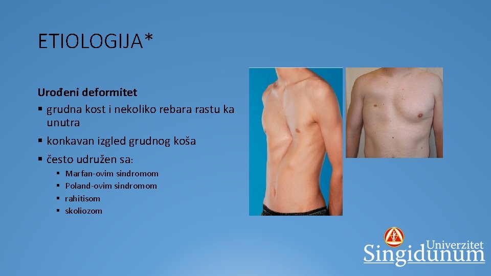 ETIOLOGIJA* Urođeni deformitet § grudna kost i nekoliko rebara rastu ka unutra § konkavan