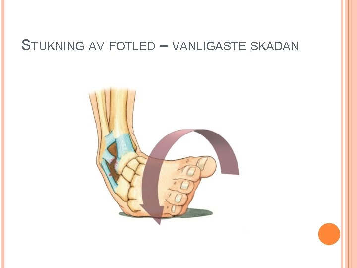 STUKNING AV FOTLED – VANLIGASTE SKADAN 