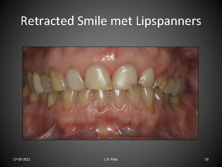 Retracted Smile met Lipspanners 17 -05 -2011 L. R. Post 18 