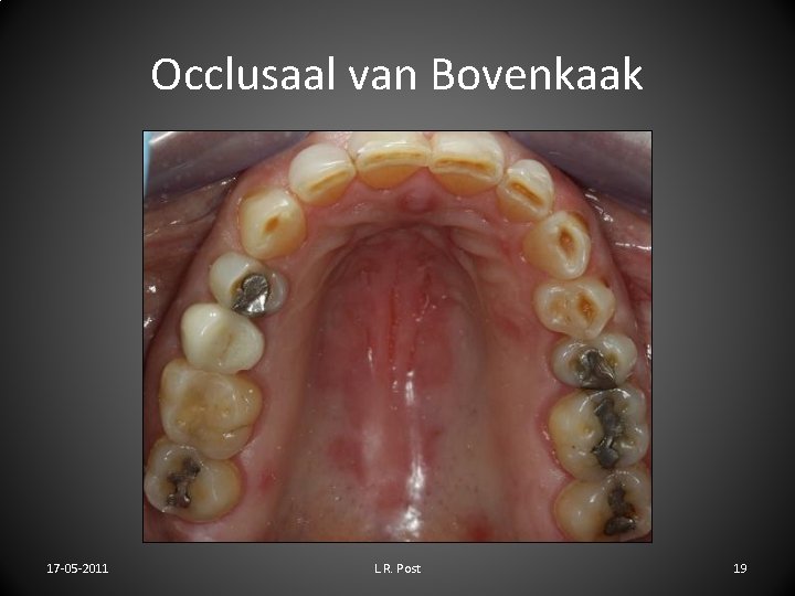 Occlusaal van Bovenkaak 17 -05 -2011 L. R. Post 19 