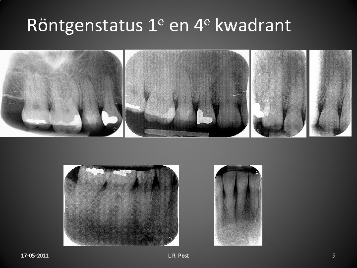 Röntgenstatus 1 e en 4 e kwadrant 17 -05 -2011 L. R. Post 9