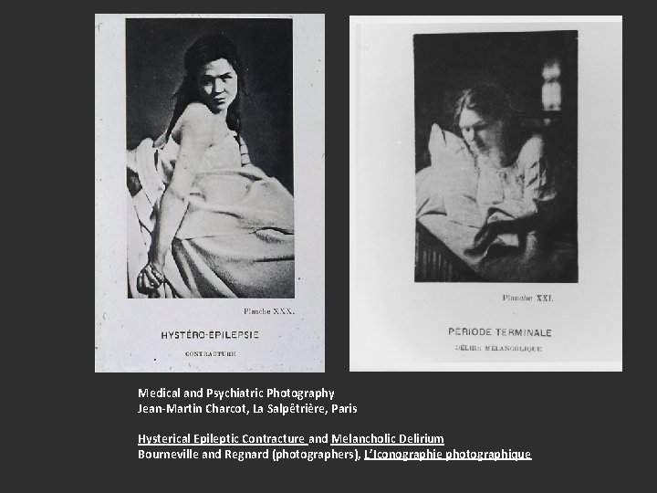 Medical and Psychiatric Photography Jean-Martin Charcot, La Salpêtrière, Paris Hysterical Epileptic Contracture and Melancholic