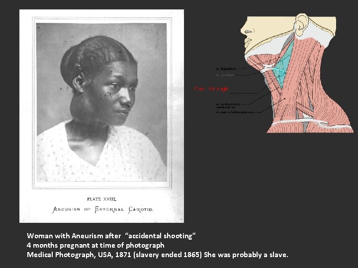 Woman with Aneurism after “accidental shooting” 4 months pregnant at time of photograph Medical