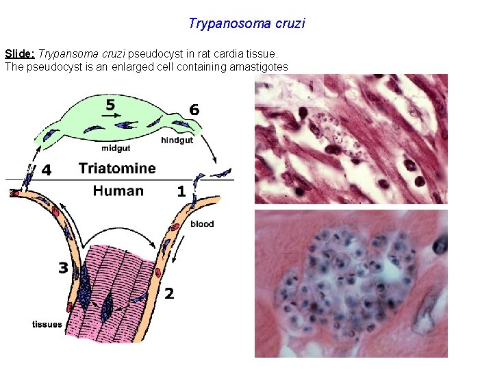 Trypanosoma cruzi Slide: Trypansoma cruzi pseudocyst in rat cardia tissue. The pseudocyst is an