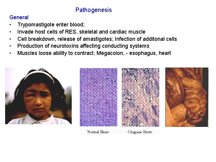 Pathogenesis General • Trypomastigote enter blood; • Invade host cells of RES, skeletal and