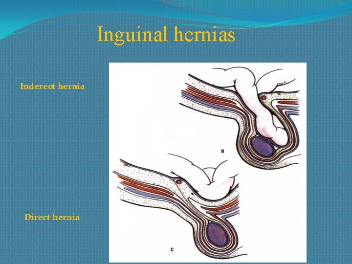 Inguinal hernias Inderect hernia Direct hernia 