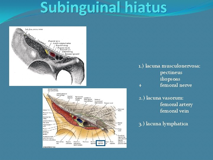 Subinguinal hiatus 1. ) lacuna musculonervosa: pectineus iliopsoas + femoral nerve 2. ) lacuna