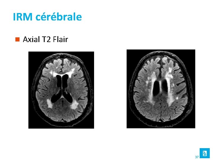 IRM cérébrale n Axial T 2 Flair 37 