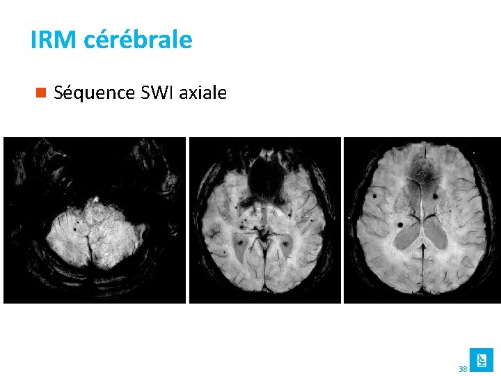 IRM cérébrale n Séquence SWI axiale 38 