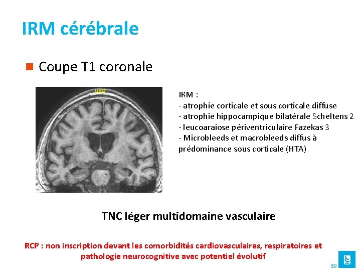 IRM cérébrale n Coupe T 1 coronale IRM : - atrophie corticale et sous