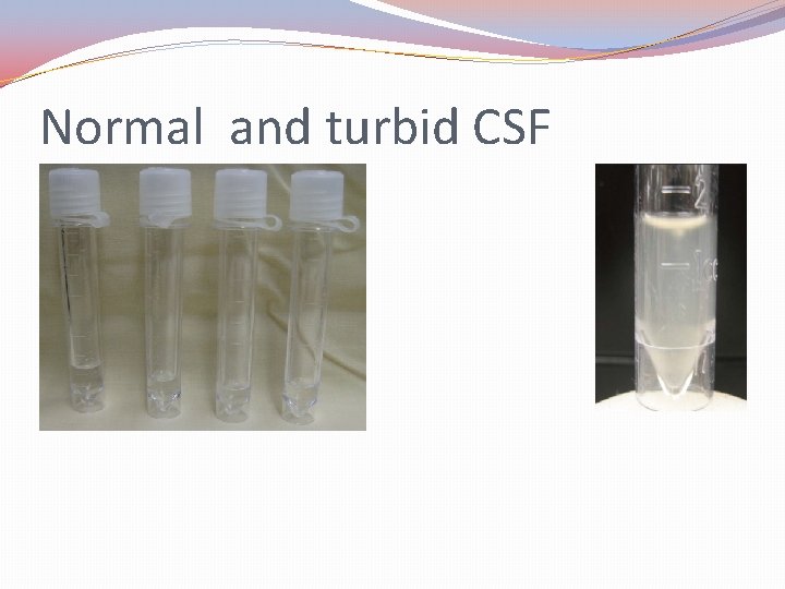 Normal and turbid CSF 