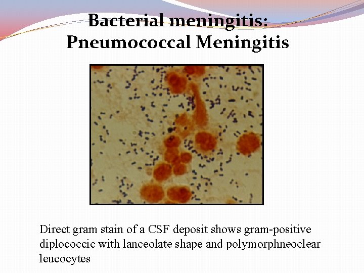 Bacterial meningitis: Pneumococcal Meningitis Direct gram stain of a CSF deposit shows gram-positive diplococcic