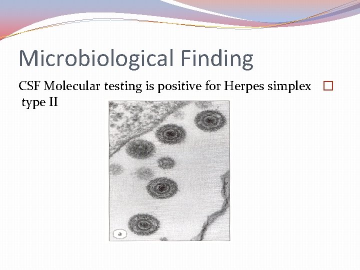 Microbiological Finding CSF Molecular testing is positive for Herpes simplex � type II 