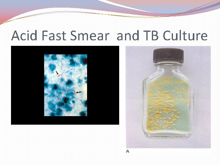Acid Fast Smear and TB Culture 