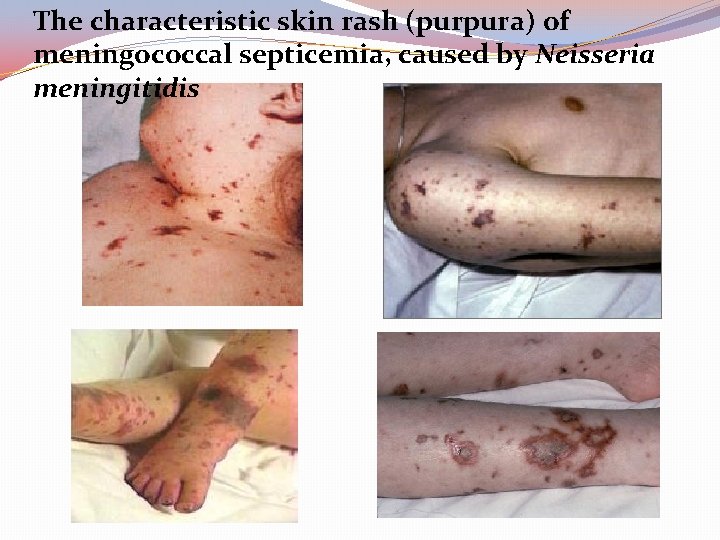 The characteristic skin rash (purpura) of meningococcal septicemia, caused by Neisseria meningitidis 