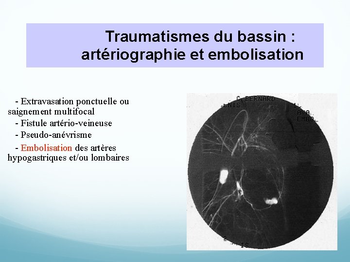 Traumatismes du bassin : artériographie et embolisation - Extravasation ponctuelle ou saignement multifocal -
