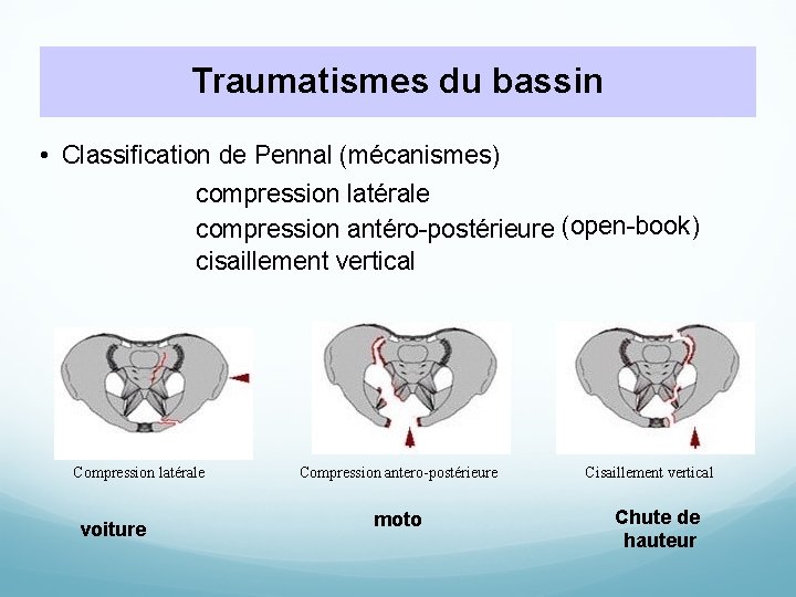 Traumatismes du bassin • Classification de Pennal (mécanismes) compression latérale compression antéro-postérieure (open-book) cisaillement