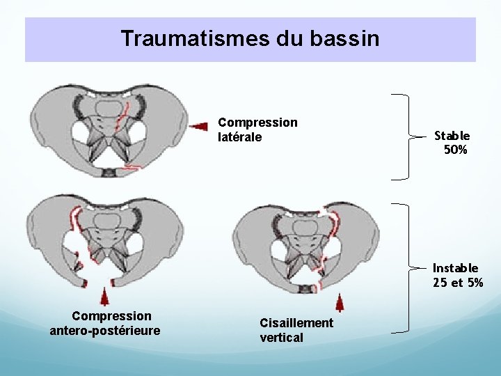 Traumatismes du bassin Compression latérale Stable 50% Instable 25 et 5% Compression antero-postérieure Cisaillement