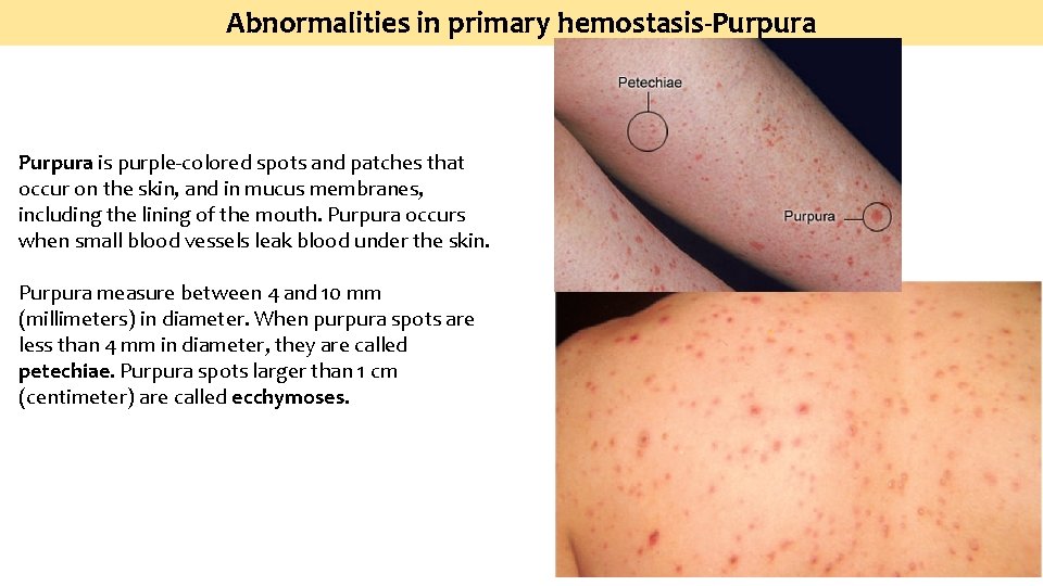 Abnormalities in primary hemostasis-Purpura is purple‐colored spots and patches that occur on the skin,