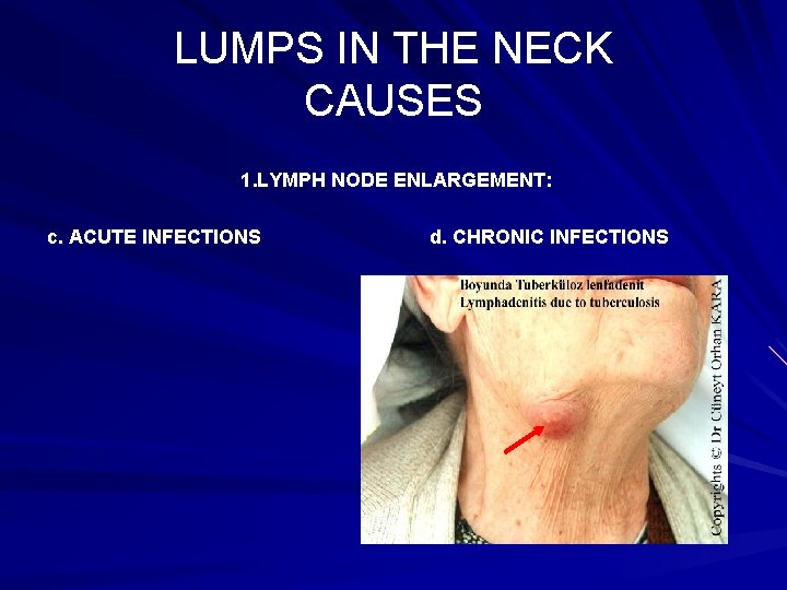 LUMPS IN THE NECK CAUSES 1. LYMPH NODE ENLARGEMENT: c. ACUTE INFECTIONS d. CHRONIC