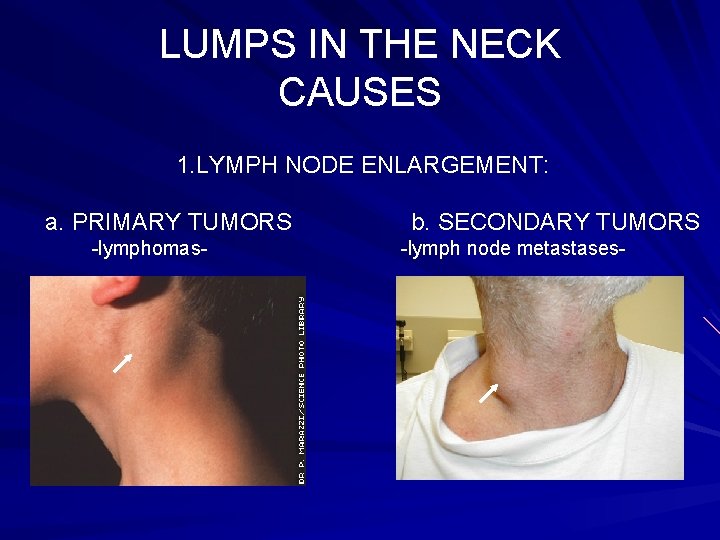 LUMPS IN THE NECK CAUSES 1. LYMPH NODE ENLARGEMENT: a. PRIMARY TUMORS -lymphomas- b.