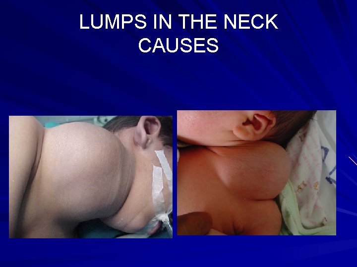 LUMPS IN THE NECK CAUSES 2. CONGENITAL CYST: c. CYSTIC HYGROMA 