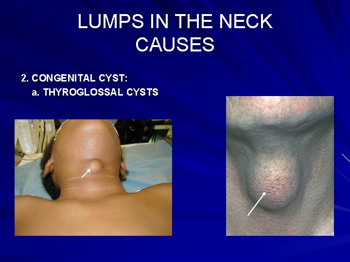 LUMPS IN THE NECK CAUSES 2. CONGENITAL CYST: a. THYROGLOSSAL CYSTS 