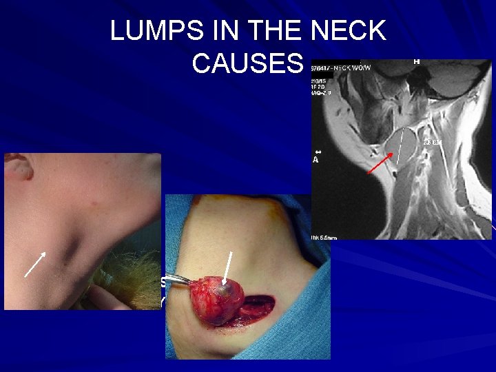 LUMPS IN THE NECK CAUSES 2. CONGENITAL CYST: b. BRANCHIAL CYST 