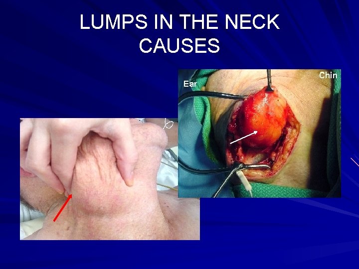 LUMPS IN THE NECK CAUSES 3. LUMPS IN THE SKIN: a. LIPOMA 