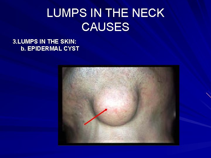 LUMPS IN THE NECK CAUSES 3. LUMPS IN THE SKIN: b. EPIDERMAL CYST 