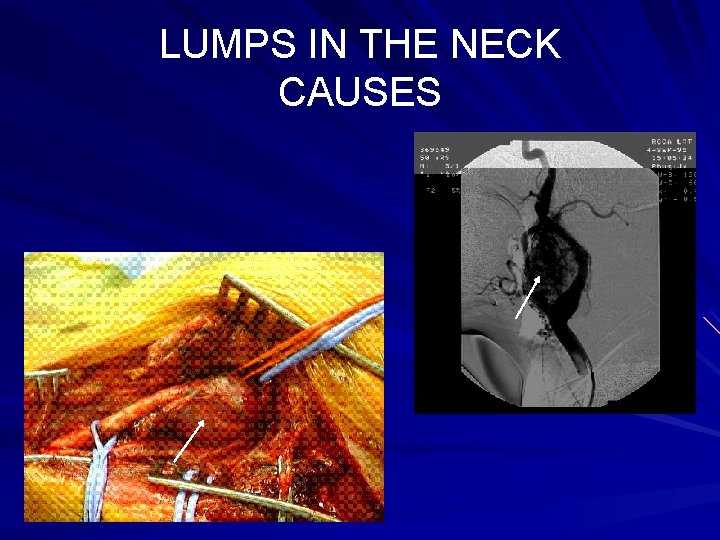 LUMPS IN THE NECK CAUSES 4. RARE TUMORS: CAROTID BODY TUMORS 