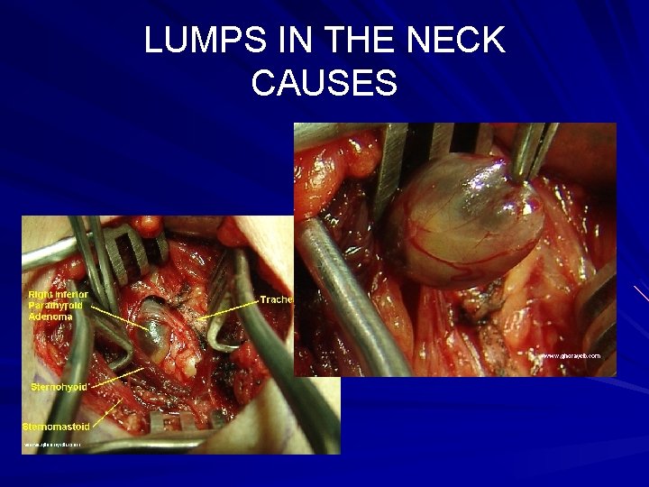 LUMPS IN THE NECK CAUSES Parathyroid adenoma 