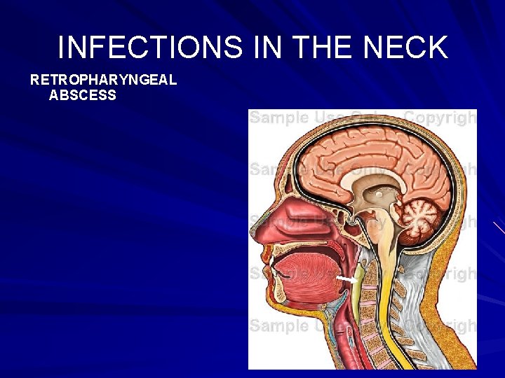 INFECTIONS IN THE NECK RETROPHARYNGEAL ABSCESS 