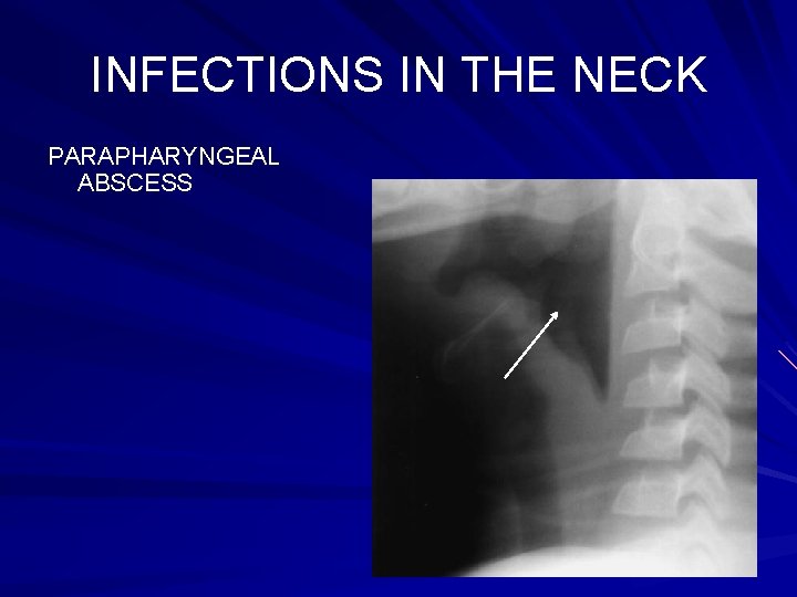 INFECTIONS IN THE NECK PARAPHARYNGEAL ABSCESS 