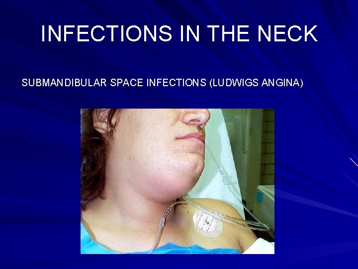 INFECTIONS IN THE NECK SUBMANDIBULAR SPACE INFECTIONS (LUDWIGS ANGINA) 