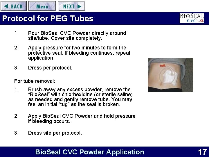 Protocol for PEG Tubes 1. Pour Bio. Seal CVC Powder directly around site/tube. Cover